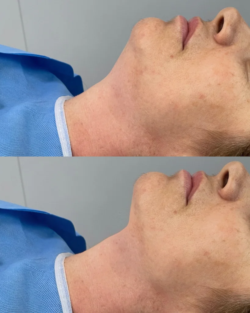 Resultados2 Endolift